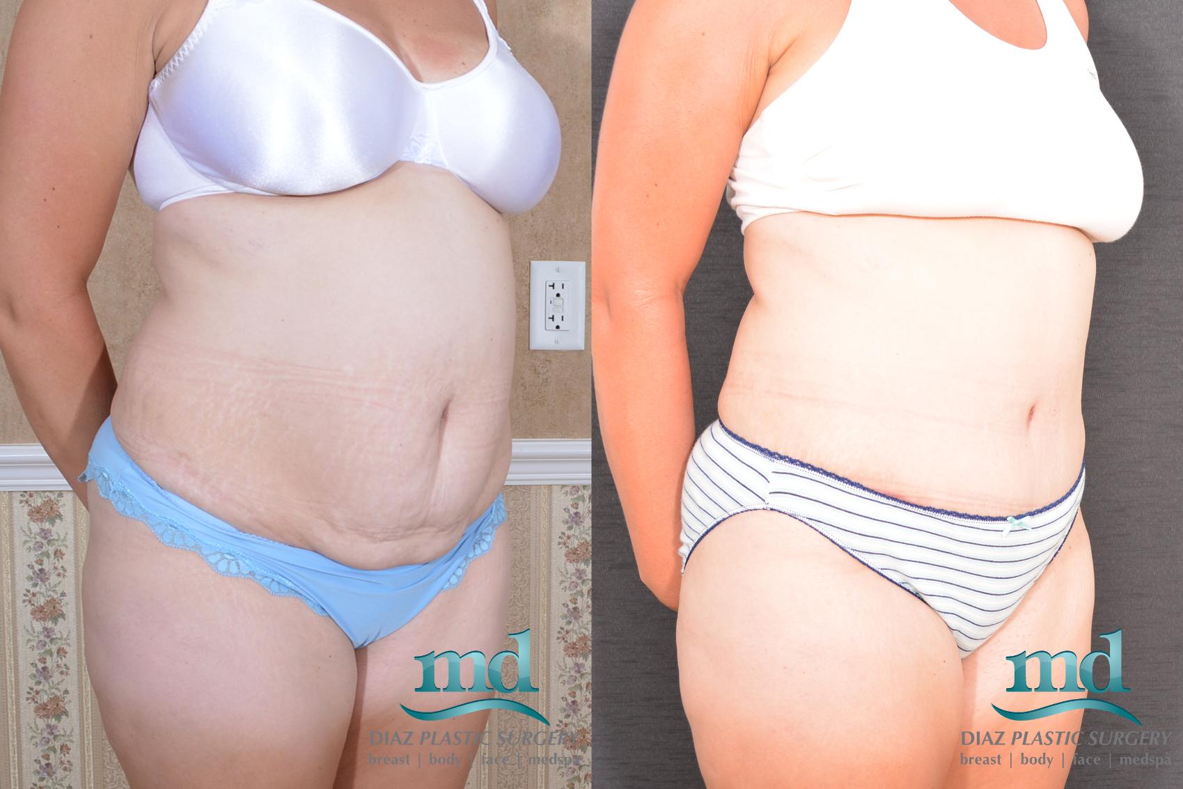 Before & After Liposuction Case 134 View #5 View in Melbourne, FL