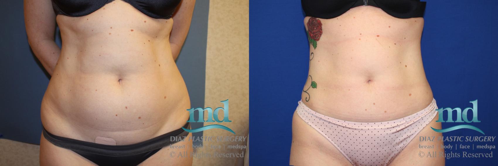 Before & After Liposuction Case 135 View #1 View in Melbourne, FL