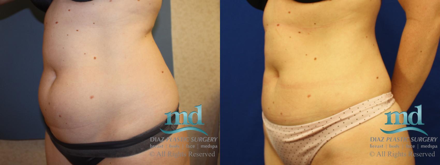 Before & After Liposuction Case 135 View #3 View in Melbourne, FL