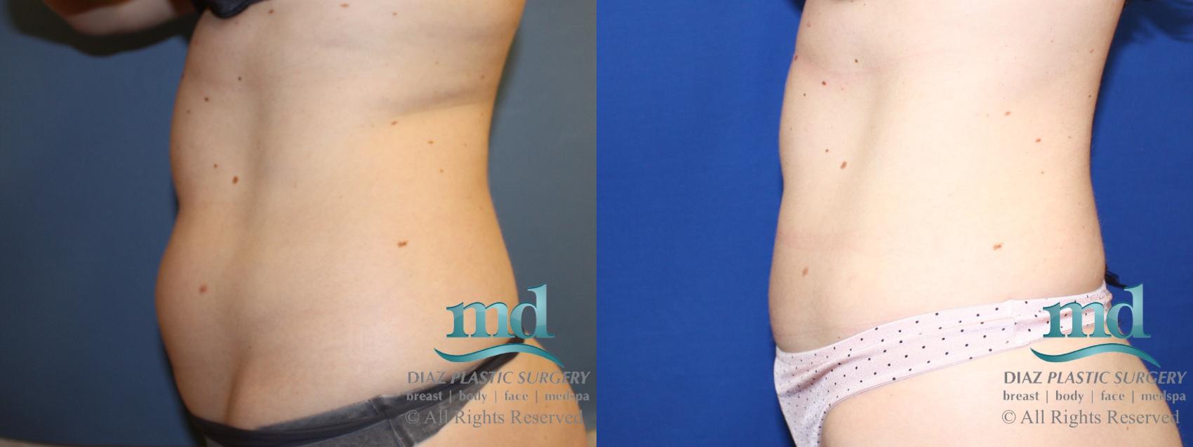 Before & After Liposuction Case 135 View #4 View in Melbourne, FL