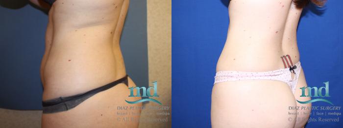 Before & After Liposuction Case 135 View #5 View in Melbourne, FL