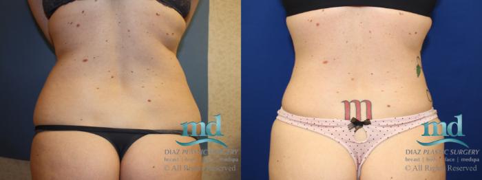 Before & After Liposuction Case 135 View #6 View in Melbourne, FL