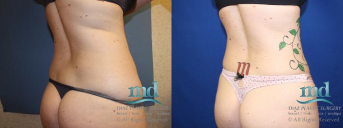 Before & After Liposuction Case 135 View #7 View in Melbourne, FL