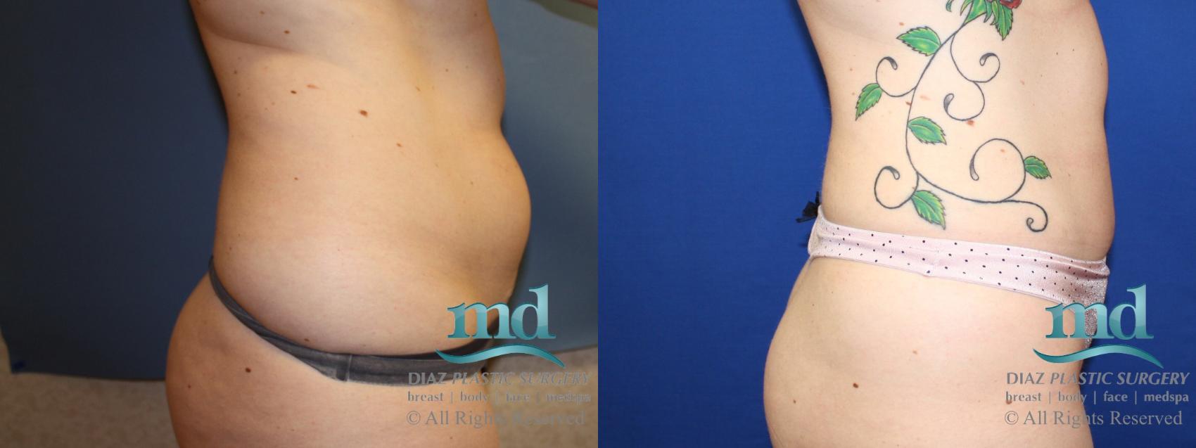 Before & After Liposuction Case 135 View #8 View in Melbourne, FL