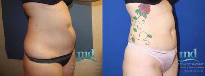 Before & After Liposuction Case 135 View #9 View in Melbourne, FL