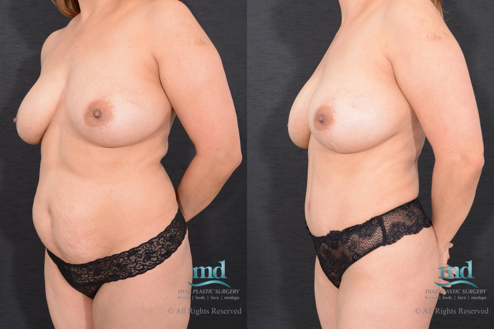 Before & After Liposuction Case 24 View #2 View in Melbourne, FL