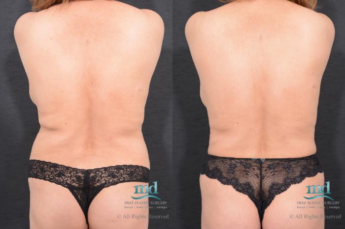 Before & After Liposuction Case 24 View #5 View in Melbourne, FL