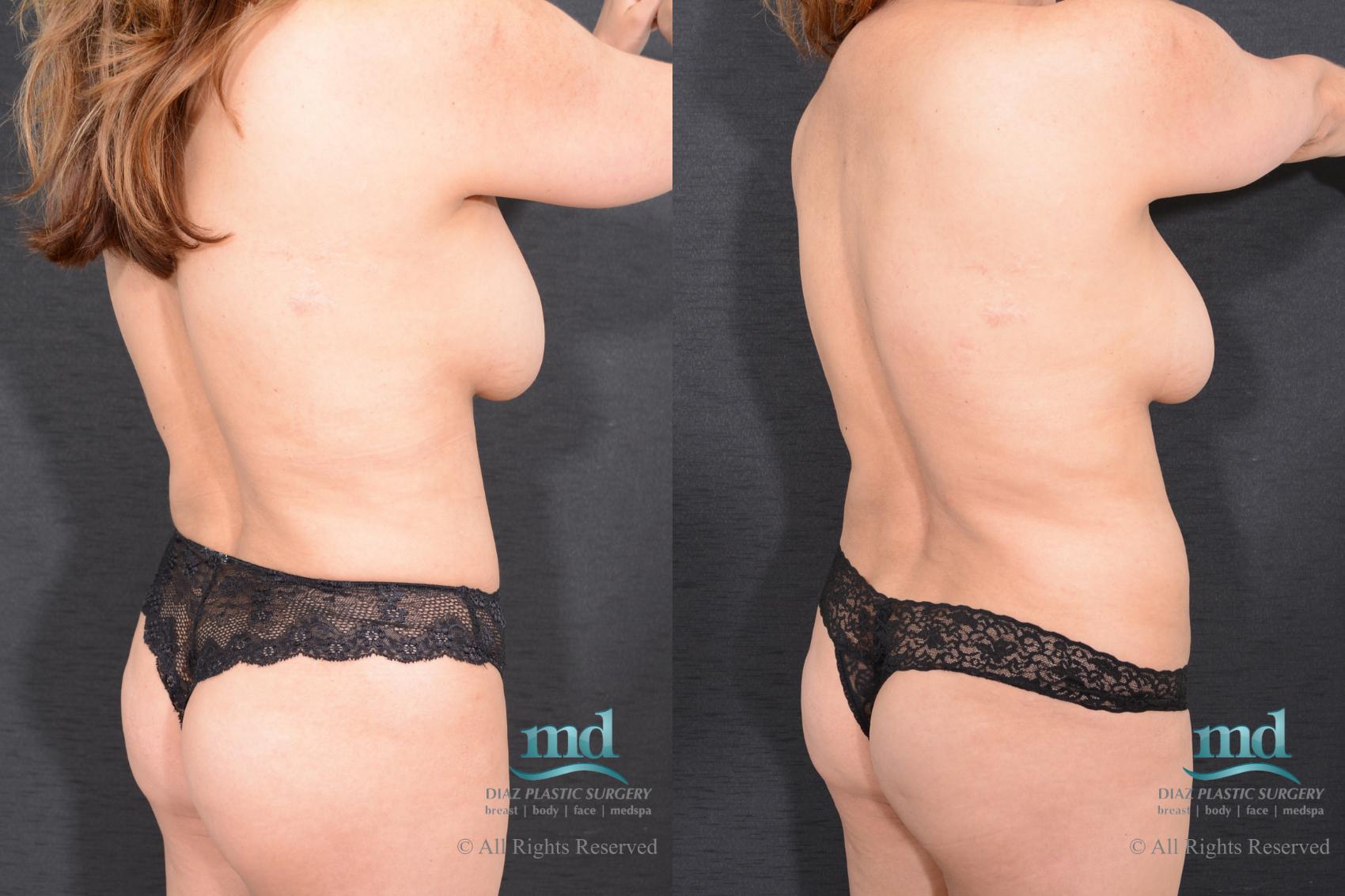 Before & After Liposuction Case 24 View #6 View in Melbourne, FL