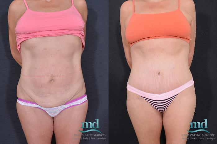 Before & After Liposuction Case 32 View #1 View in Melbourne, FL