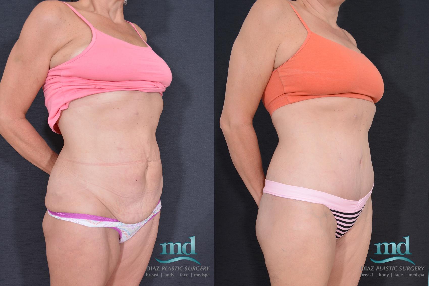 Before & After Liposuction Case 32 View #2 View in Melbourne, FL