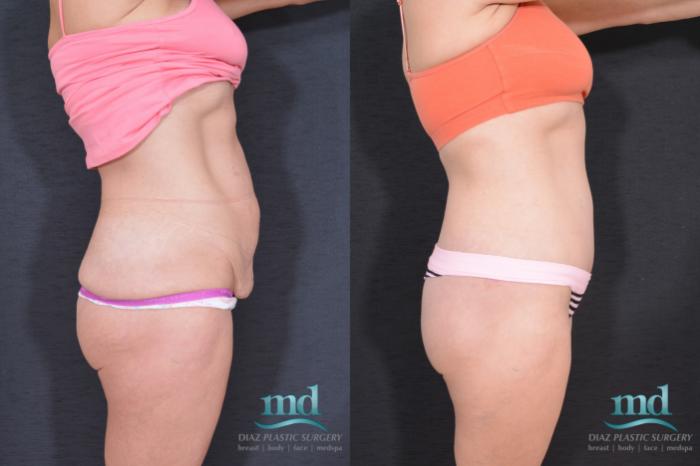 Before & After Liposuction Case 32 View #3 View in Melbourne, FL