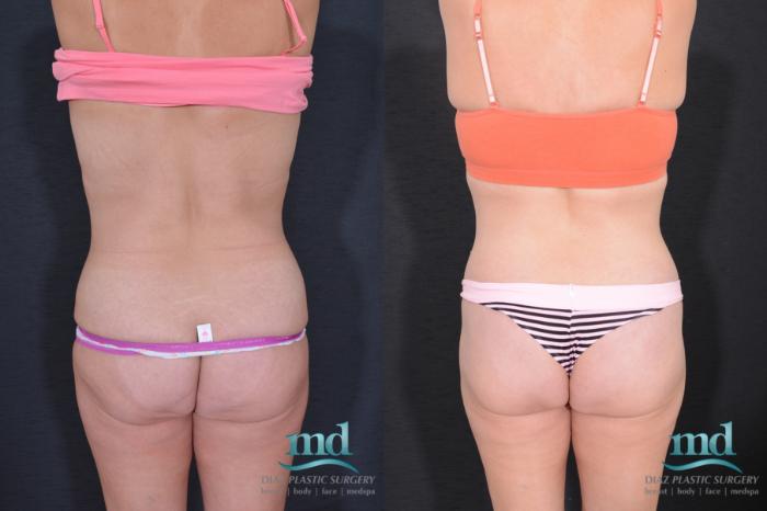 Before & After Liposuction Case 32 View #4 View in Melbourne, FL