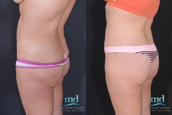 Before & After Liposuction Case 32 View #5 View in Melbourne, FL