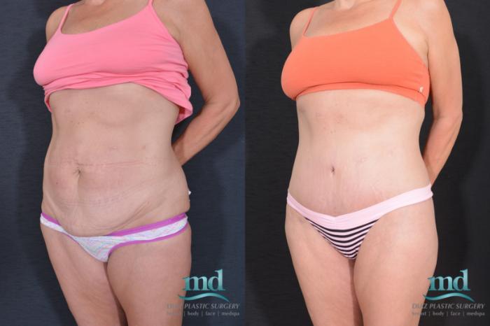 Before & After Liposuction Case 32 View #6 View in Melbourne, FL