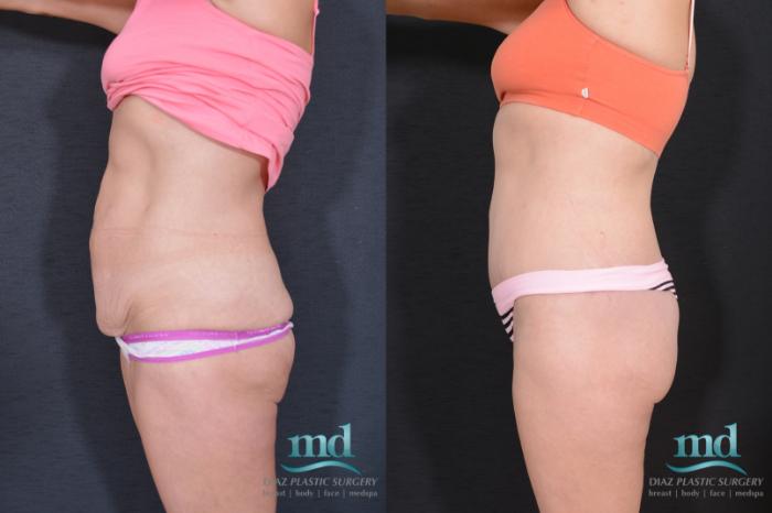 Before & After Liposuction Case 32 View #7 View in Melbourne, FL