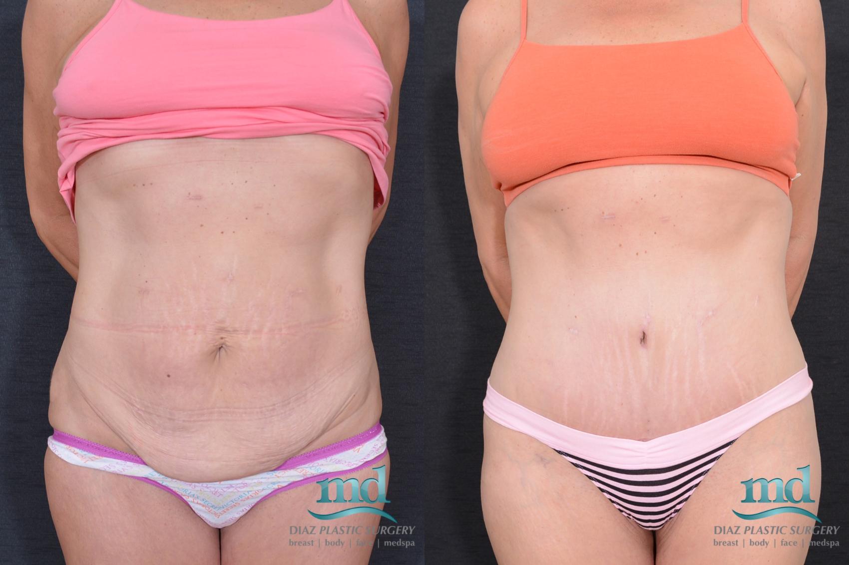 Before & After Liposuction Case 32 View #9 View in Melbourne, FL