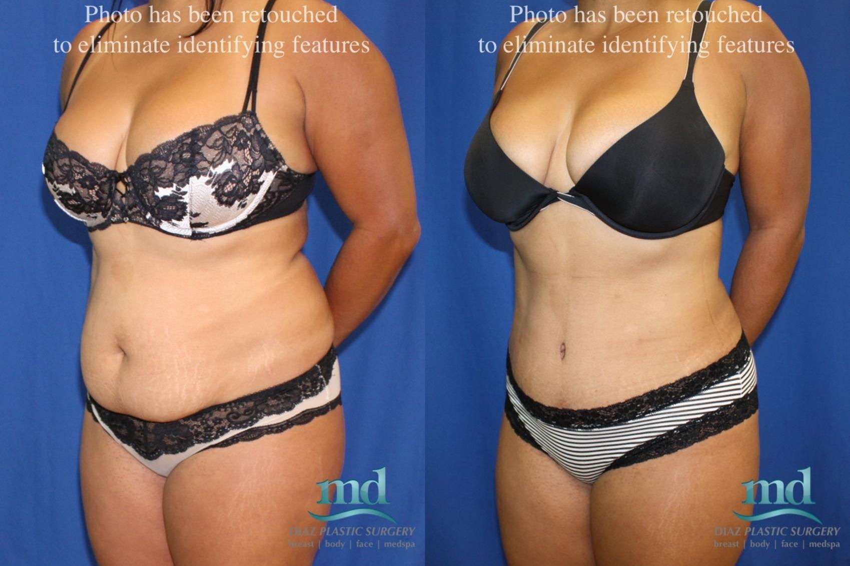 Three quarter left-side view photograph of Case #6 before and after image of a tummy tuck showing a slimmer torso after fat and skin was removed. 