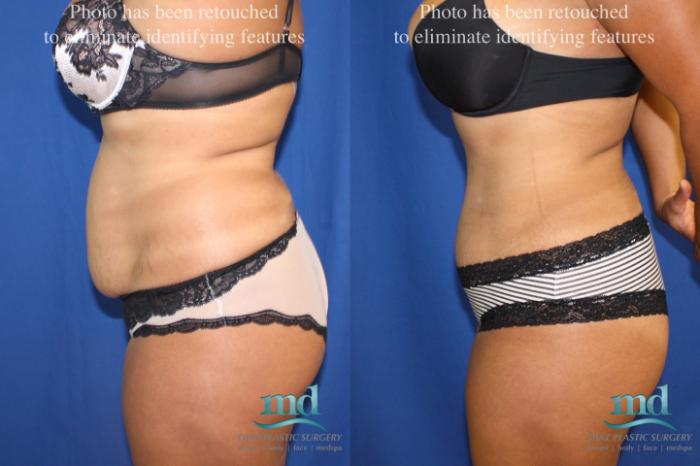 Before & After Liposuction Case 6 View #3 View in Melbourne, FL