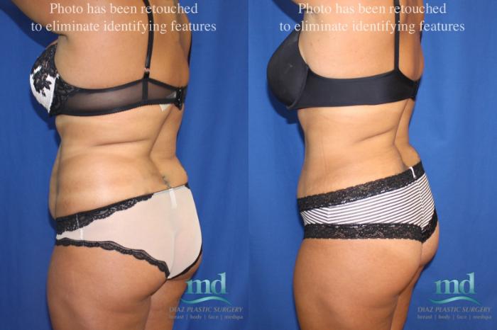 Before & After Liposuction Case 6 View #4 View in Melbourne, FL