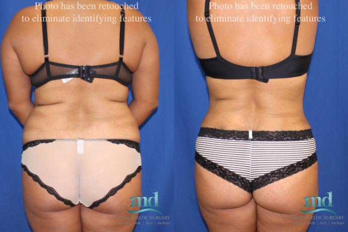 Before & After Liposuction Case 6 View #5 View in Melbourne, FL