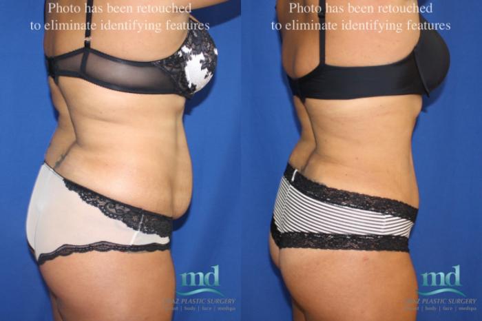 Before & After Liposuction Case 6 View #6 View in Melbourne, FL