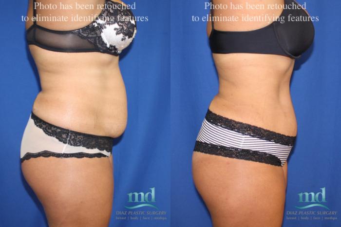 Before & After Liposuction Case 6 View #7 View in Melbourne, FL