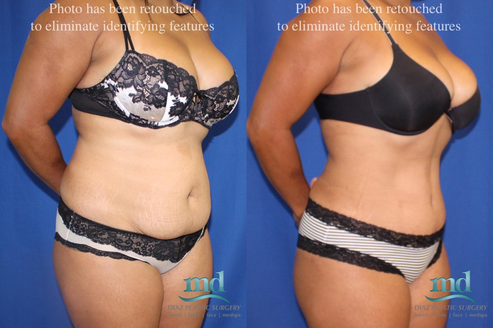 Before & After Liposuction Case 6 View #8 View in Melbourne, FL