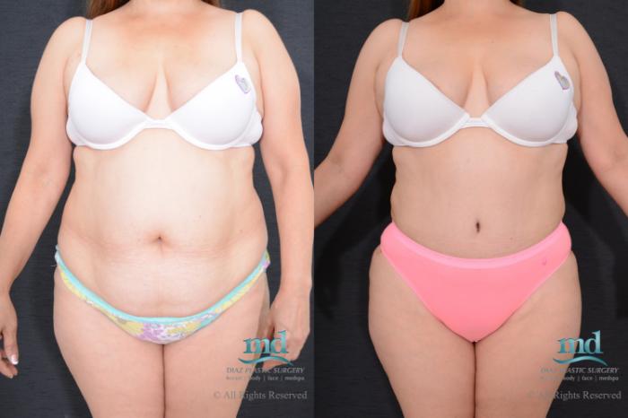 Before & After Liposuction Case 79 View #1 View in Melbourne, FL