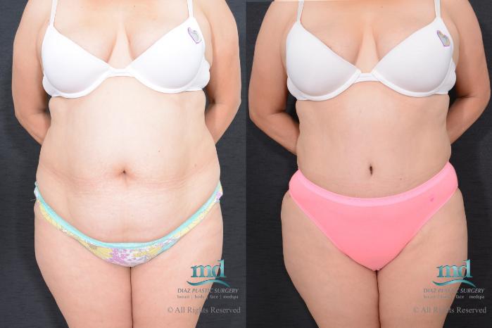 Before & After Liposuction Case 79 View #2 View in Melbourne, FL