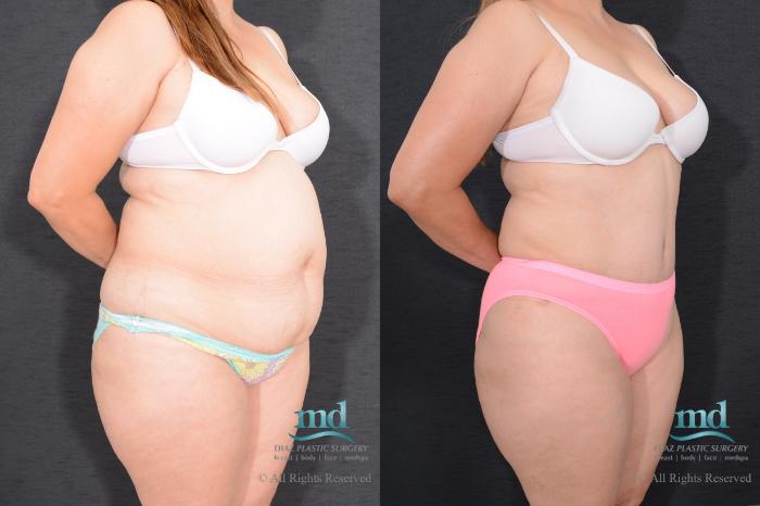Before & After Liposuction Case 79 View #3 View in Melbourne, FL