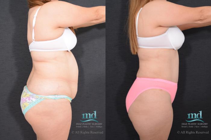 Before & After Liposuction Case 79 View #4 View in Melbourne, FL