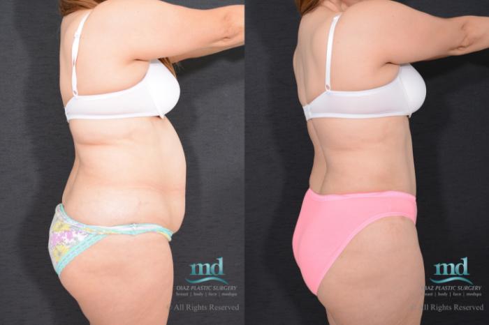 Before & After Liposuction Case 79 View #5 View in Melbourne, FL
