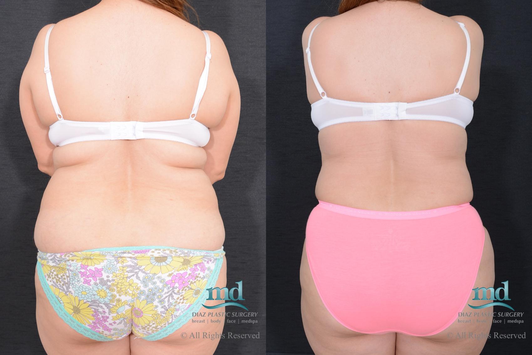 Before & After Liposuction Case 79 View #6 View in Melbourne, FL