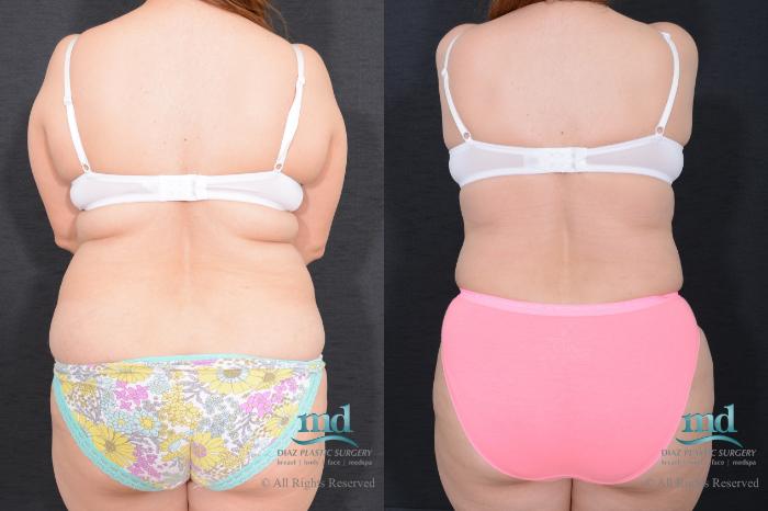 Before & After Liposuction Case 79 View #6 View in Melbourne, FL