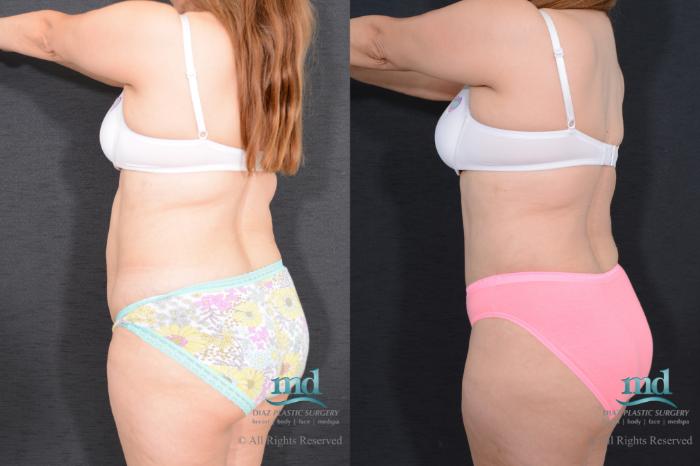 Before & After Liposuction Case 79 View #7 View in Melbourne, FL