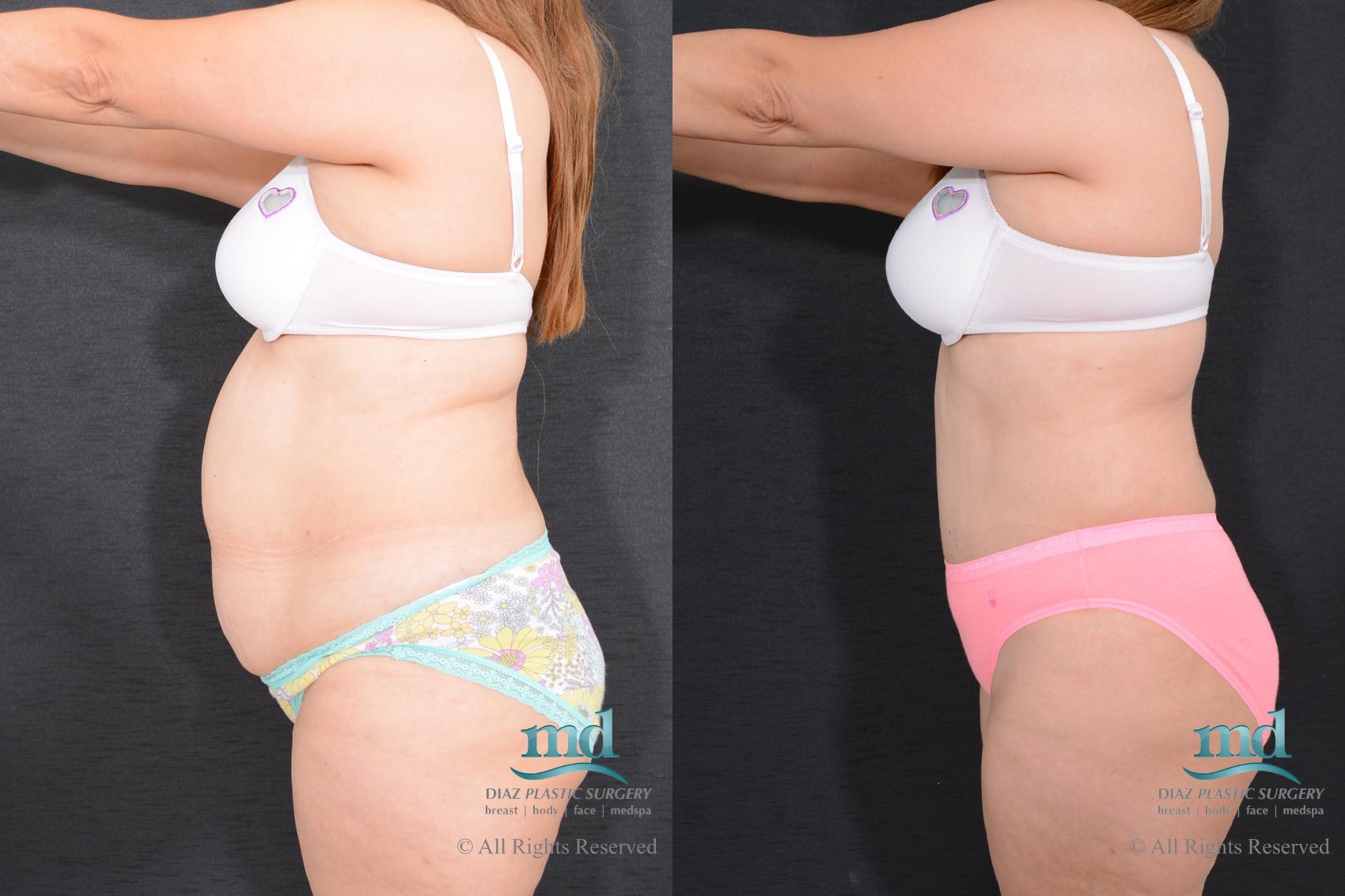 Before & After Liposuction Case 79 View #8 View in Melbourne, FL