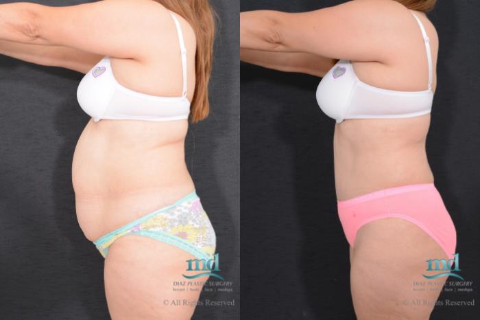 Before & After Liposuction Case 79 View #8 View in Melbourne, FL