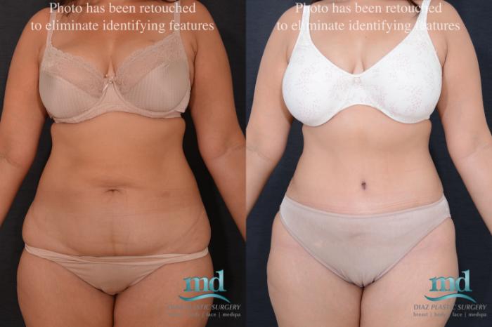 Before & After Liposuction Case 81 View #1 View in Melbourne, FL
