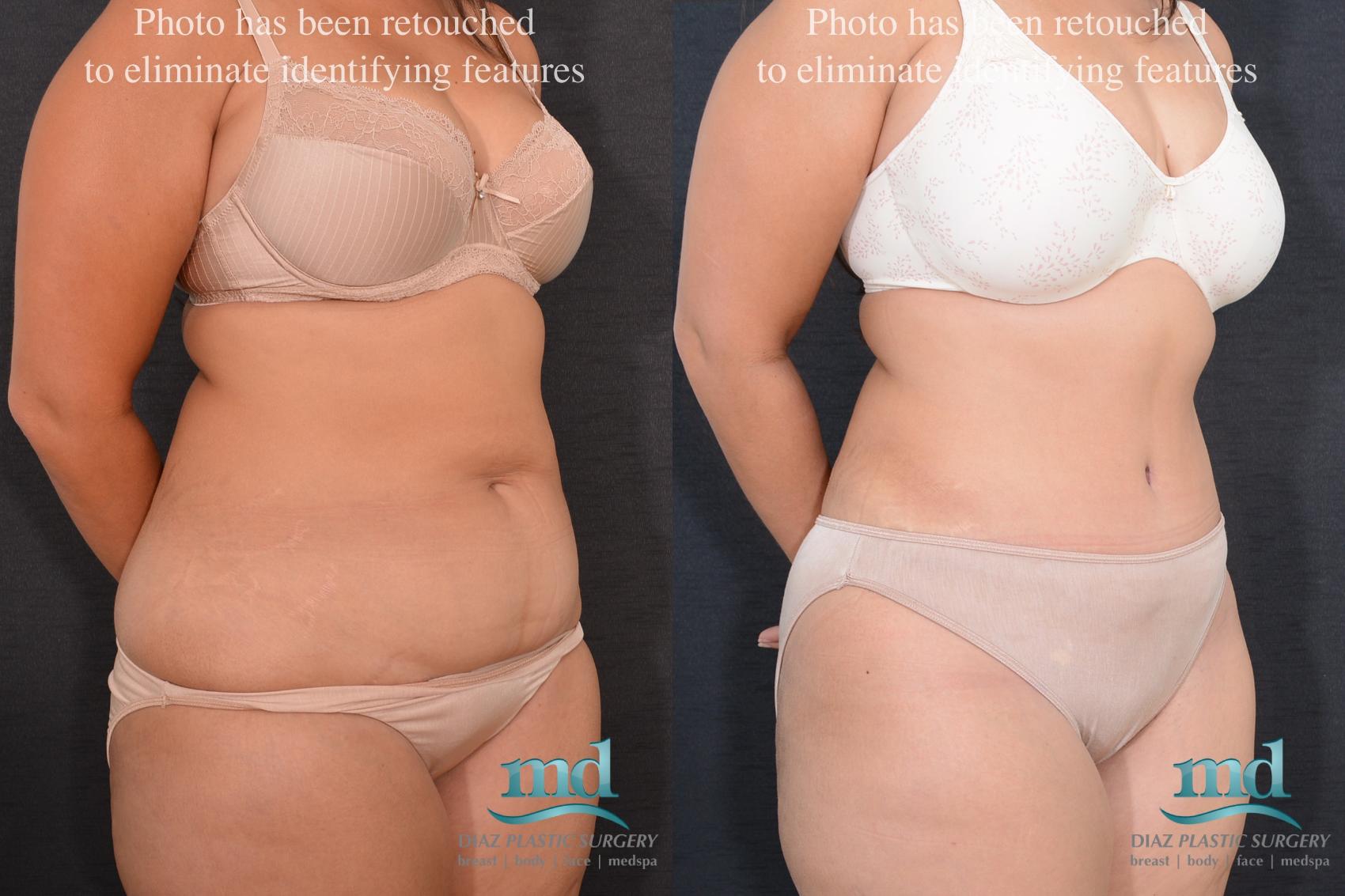 Before & After Liposuction Case 81 View #2 View in Melbourne, FL