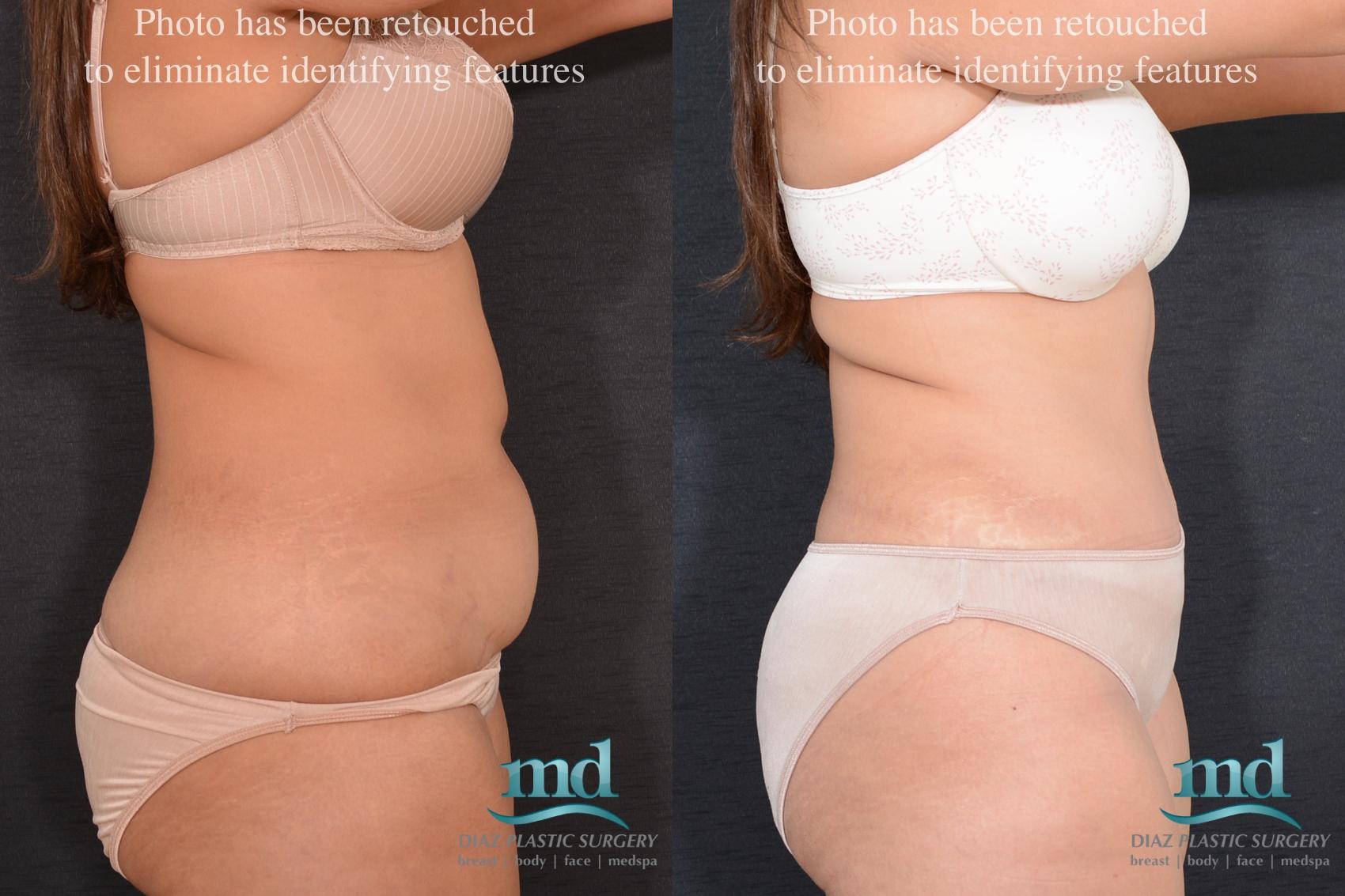 Before & After Liposuction Case 81 View #3 View in Melbourne, FL