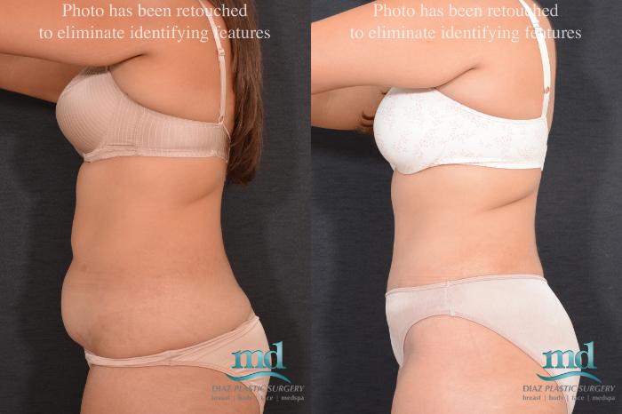 Before & After Liposuction Case 81 View #4 View in Melbourne, FL