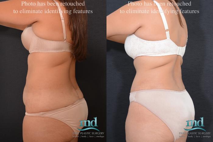 Before & After Liposuction Case 81 View #5 View in Melbourne, FL