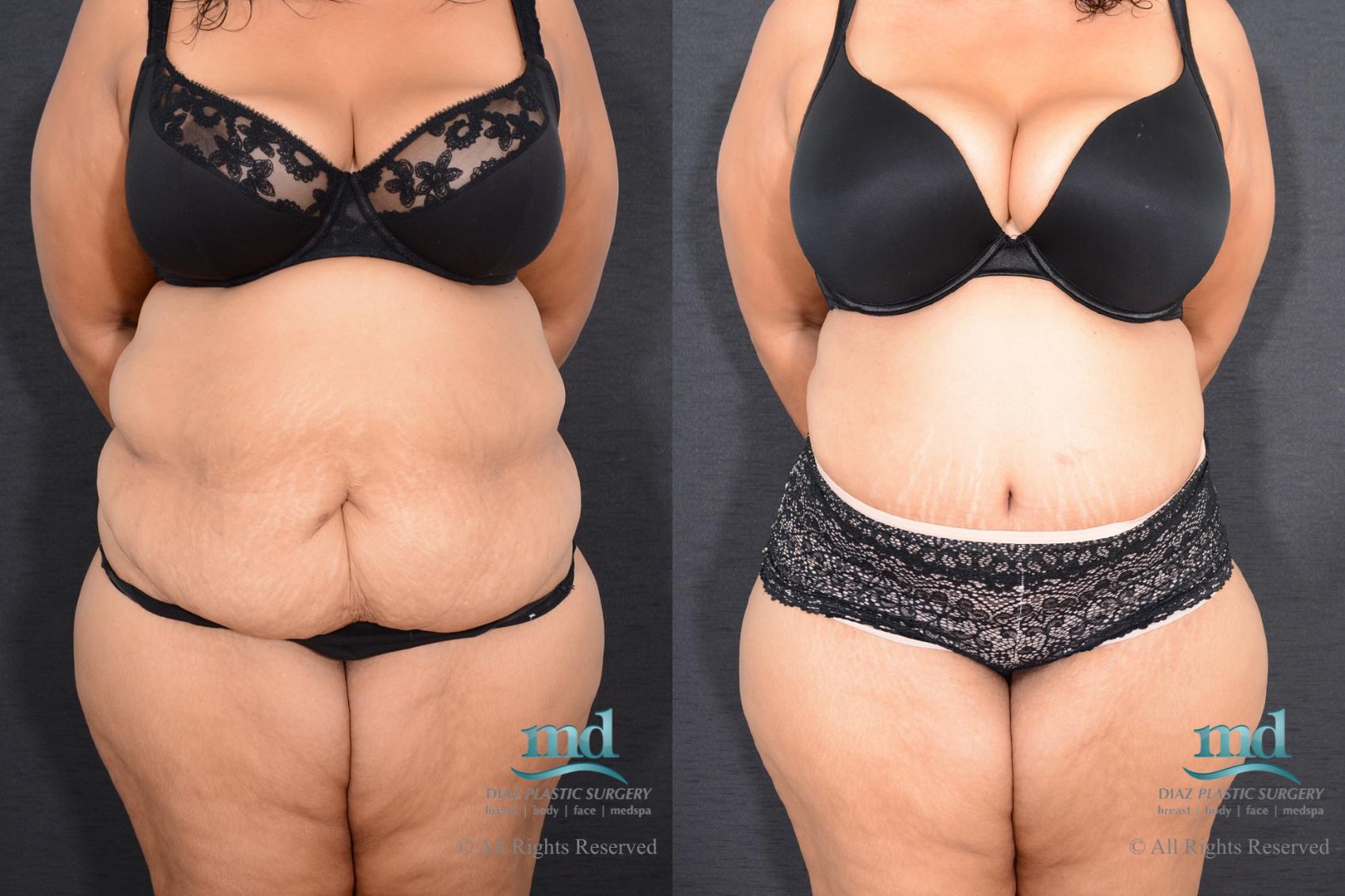 Before & After Liposuction Case 85 View #1 View in Melbourne, FL