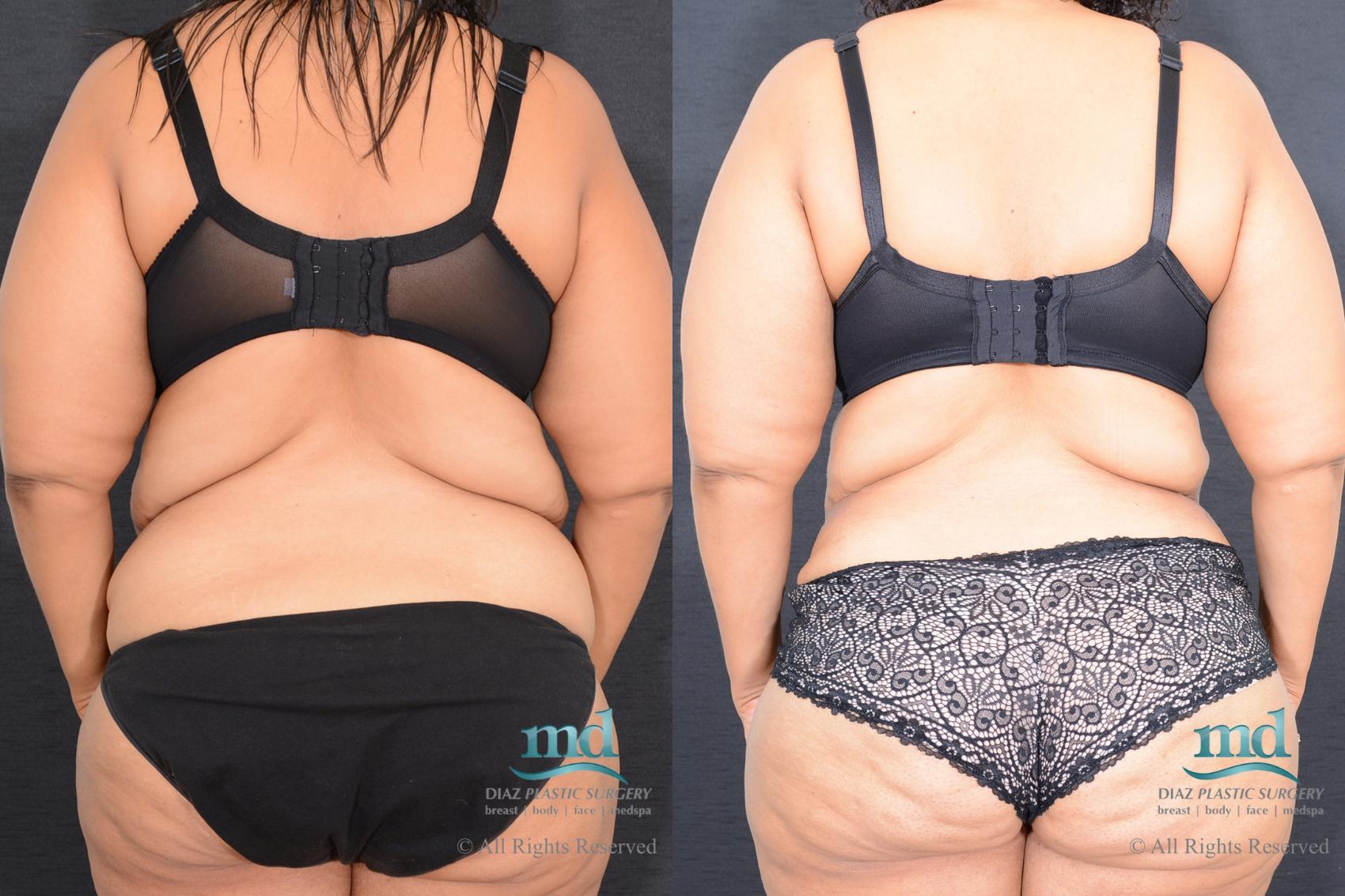 Before & After Liposuction Case 85 View #2 View in Melbourne, FL