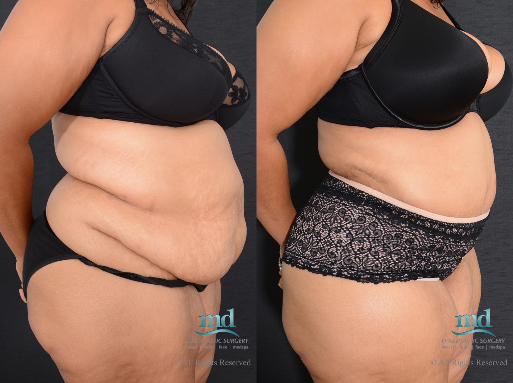 Before & After Liposuction Case 85 View #3 View in Melbourne, FL