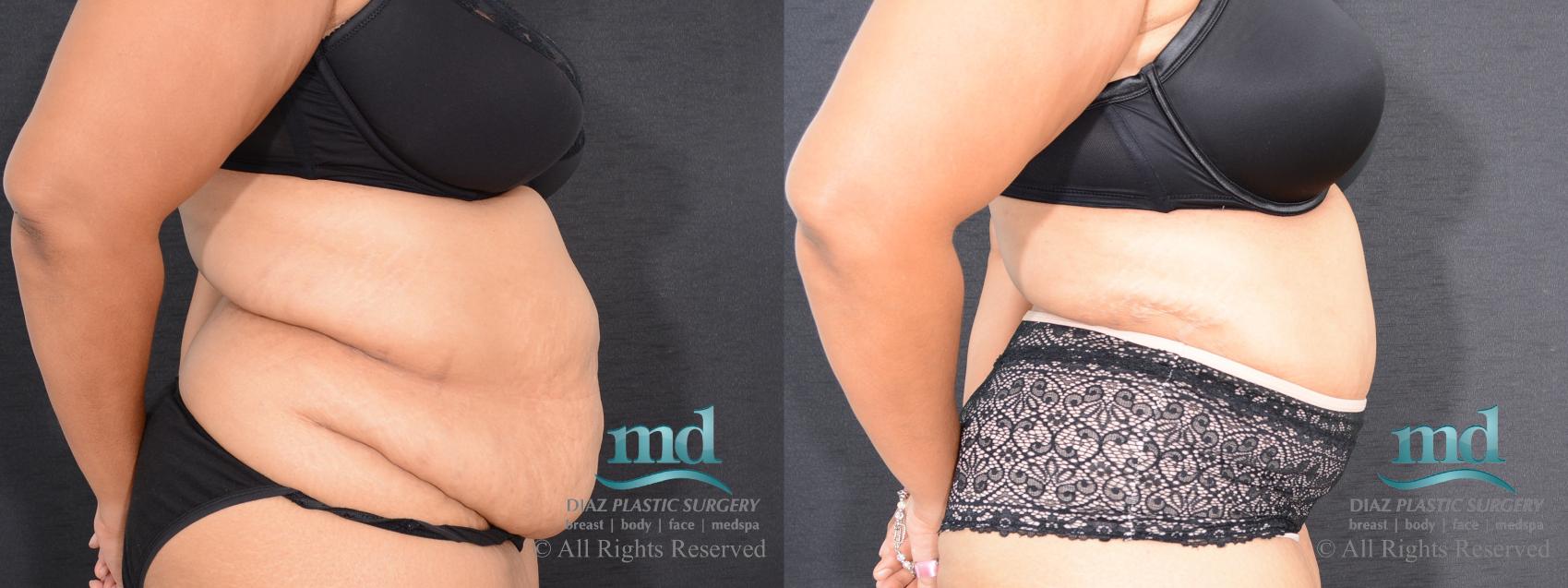 Before & After Liposuction Case 85 View #4 View in Melbourne, FL