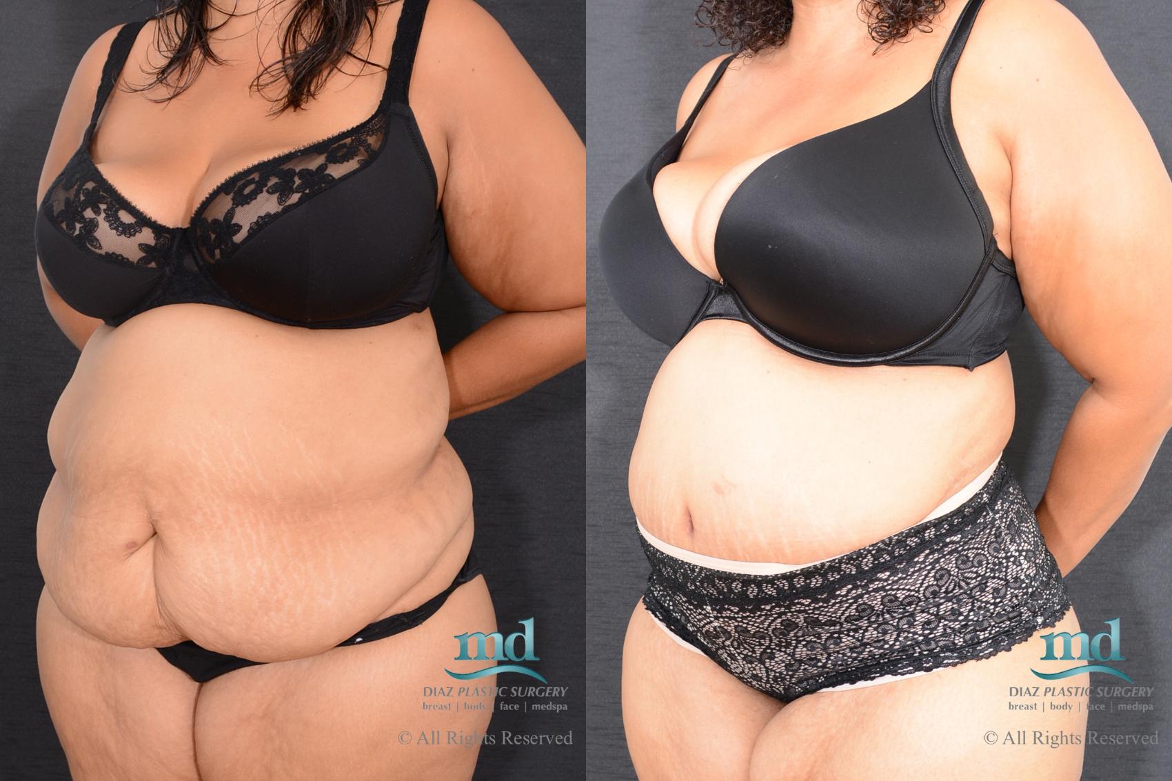Before & After Liposuction Case 85 View #5 View in Melbourne, FL