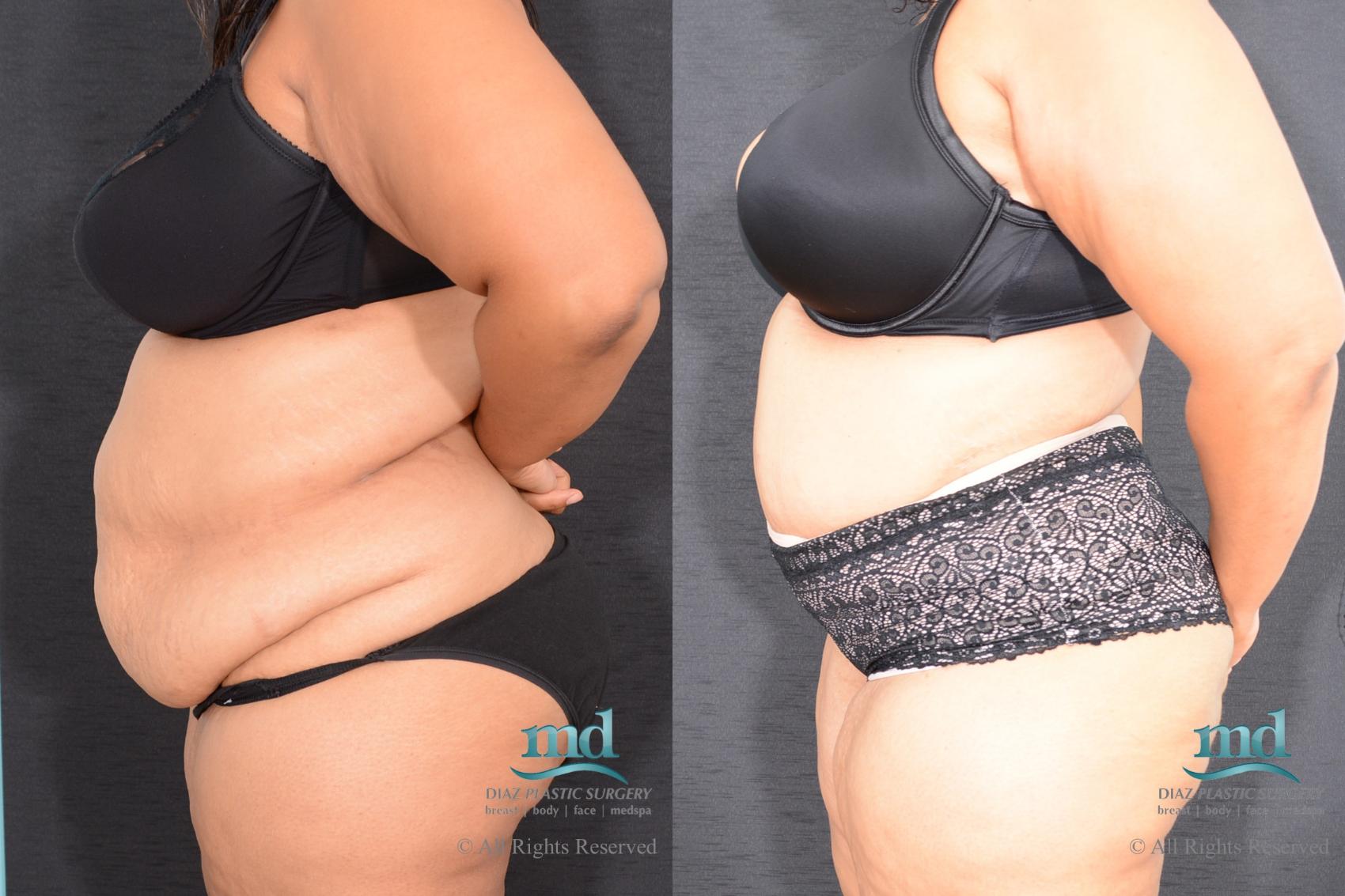 Before & After Liposuction Case 85 View #6 View in Melbourne, FL