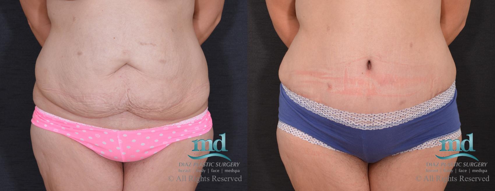 Before & After Liposuction Case 86 View #1 View in Melbourne, FL