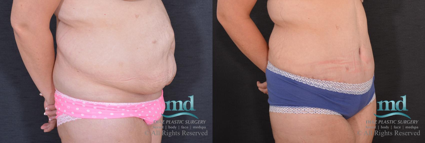 Before & After Liposuction Case 86 View #2 View in Melbourne, FL